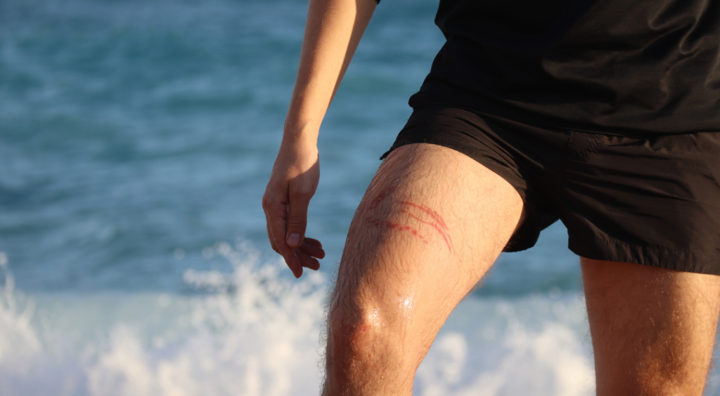 queimadura de água-viva