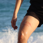 queimadura de água-viva