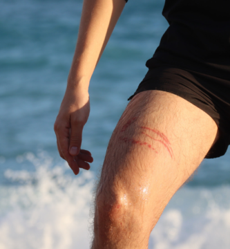 queimadura de água-viva