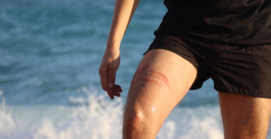 queimadura de água-viva